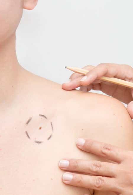 Effective-Treatment-for-Skin-Cancer