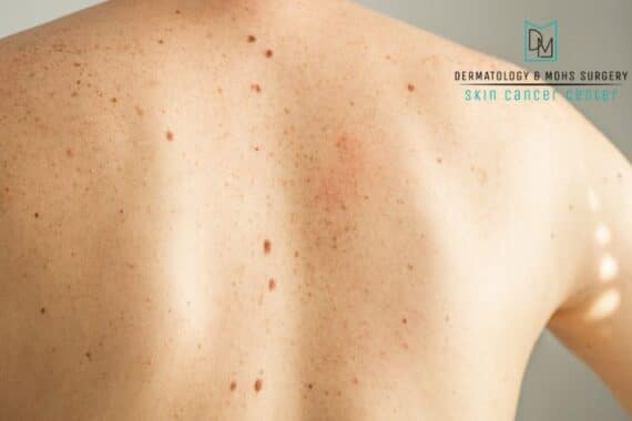 skin cancer symptoms