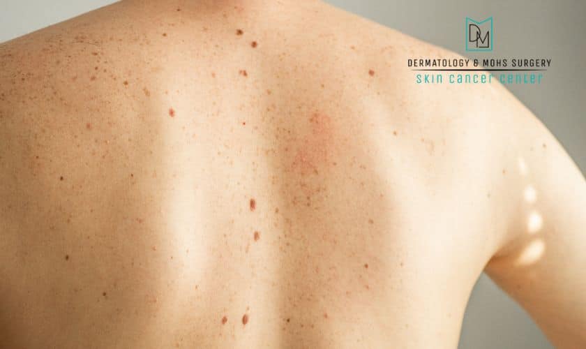 skin cancer symptoms