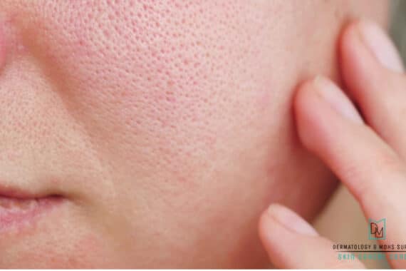 How To Reduce Skin Pore Size Naturally