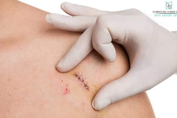 Healing After Mohs Surgery on Your Face