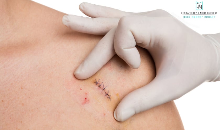Healing After Mohs Surgery on Your Face