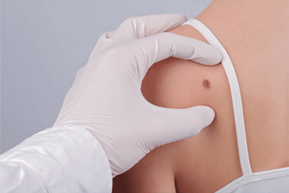 Exploring the Mohs Micrographic Surgery Process: What to Expect