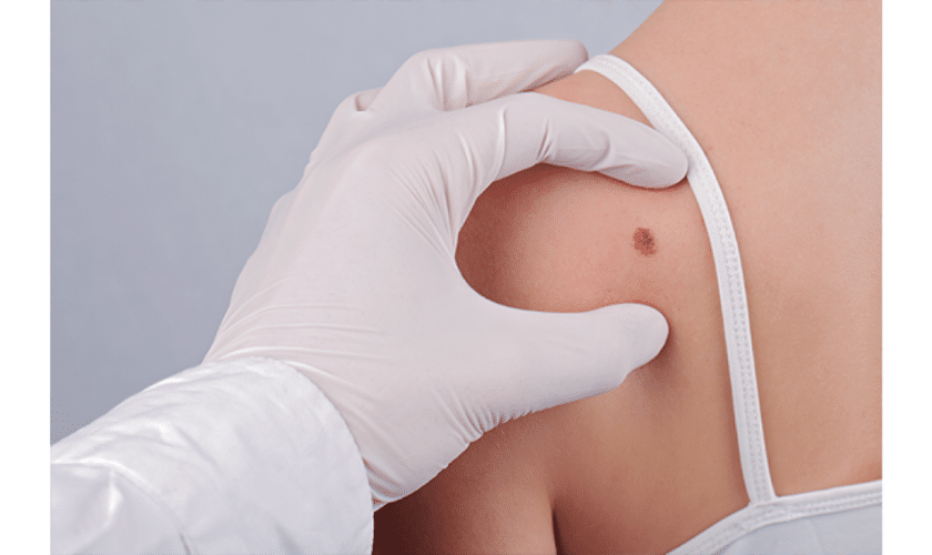 Exploring the Mohs Micrographic Surgery Process: What to Expect