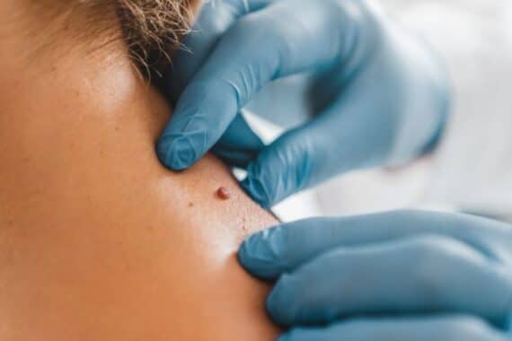 How Mohs Surgery Helps Preserve Your Skin On This Independence Day