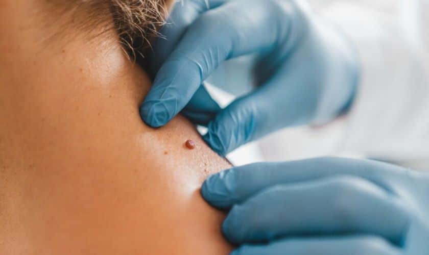 How Mohs Surgery Helps Preserve Your Skin On This Independence Day