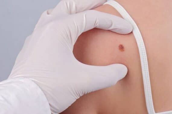 Is Mohs Surgery the Right Choice for You? Find Out Here