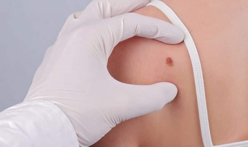 Is Mohs Surgery the Right Choice for You? Find Out Here