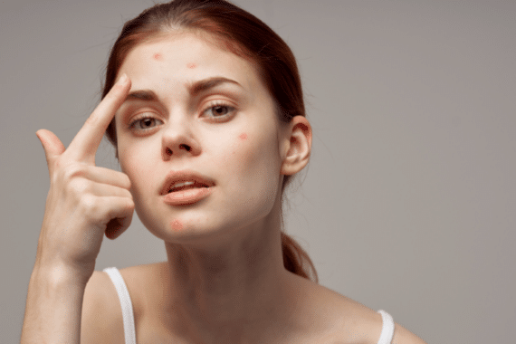 The Ultimate Guide to Acne: Types, Triggers, and Treatments