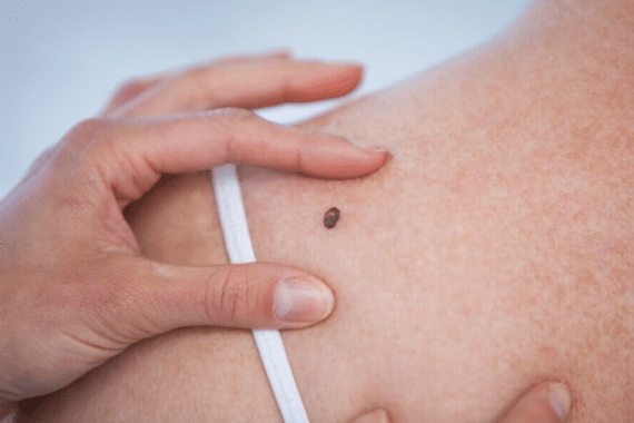 Demystifying Mohs Surgery: Key Facts About Skin Cancer