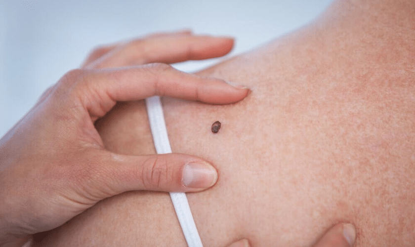 Demystifying Mohs Surgery: Key Facts About Skin Cancer