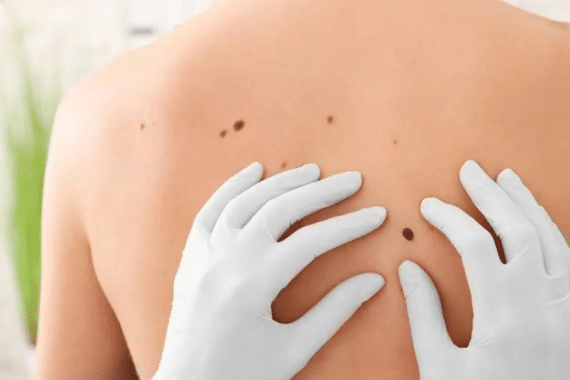 Mohs Surgery Unveiled: Insights Into Effective Skin Cancer Treatment