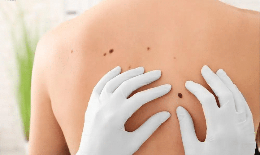 Mohs Surgery Unveiled: Insights Into Effective Skin Cancer Treatment