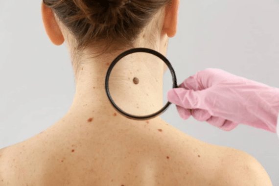 Who Can Benefit From Mohs Surgery? Exploring Eligibility Criteria