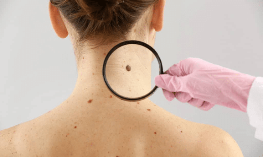 Who Can Benefit From Mohs Surgery? Exploring Eligibility Criteria