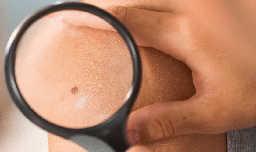 Choosing Your Surgical Path: Mohs Surgery vs. Traditional Surgery