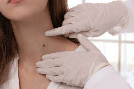 Is Mohs Surgery the Best Treatment for Skin Cancer
