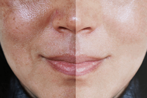 How To Fix A Sun Damaged Skin