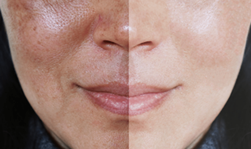 How To Fix A Sun Damaged Skin