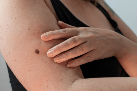 Your Summer Guide To Skin Cancer Prevention, Symptoms & Treatment Options