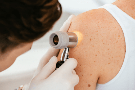 surgical dermatology to approach melanoma management