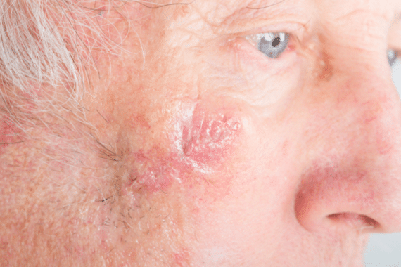 how long does it take to heal after mohs surgery