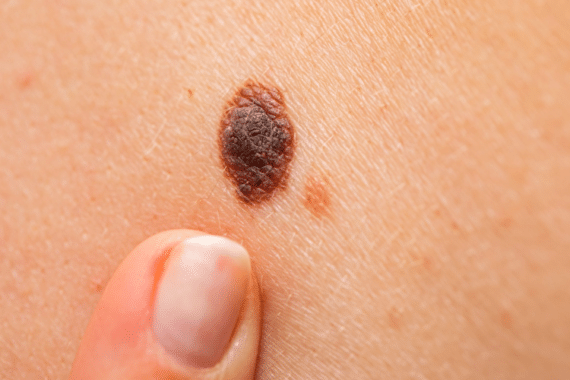 How serious is melanoma