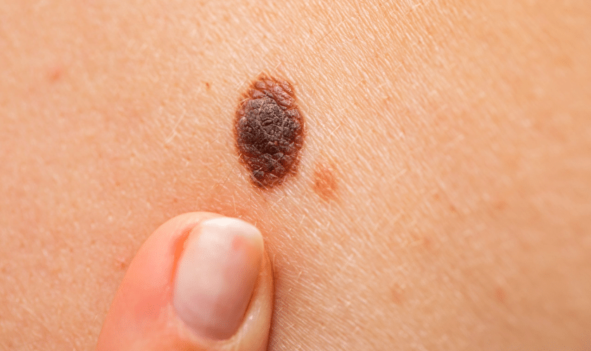 How serious is melanoma