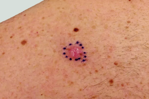 how to detect skin cancer early