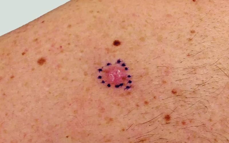 how to detect skin cancer early