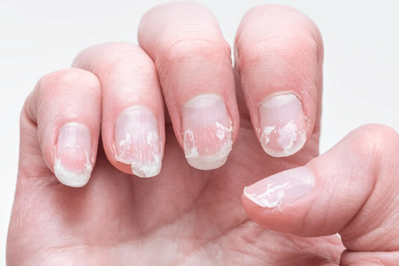 What are the 5 most common nail disorders