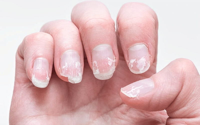 Essential Insights into the 5 Most Common Nail Disorders