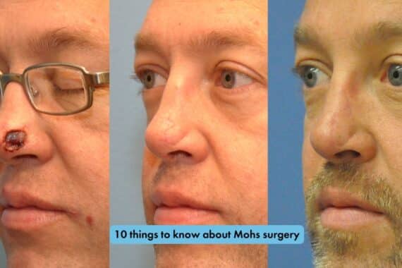 10 things to know about Mohs surgery