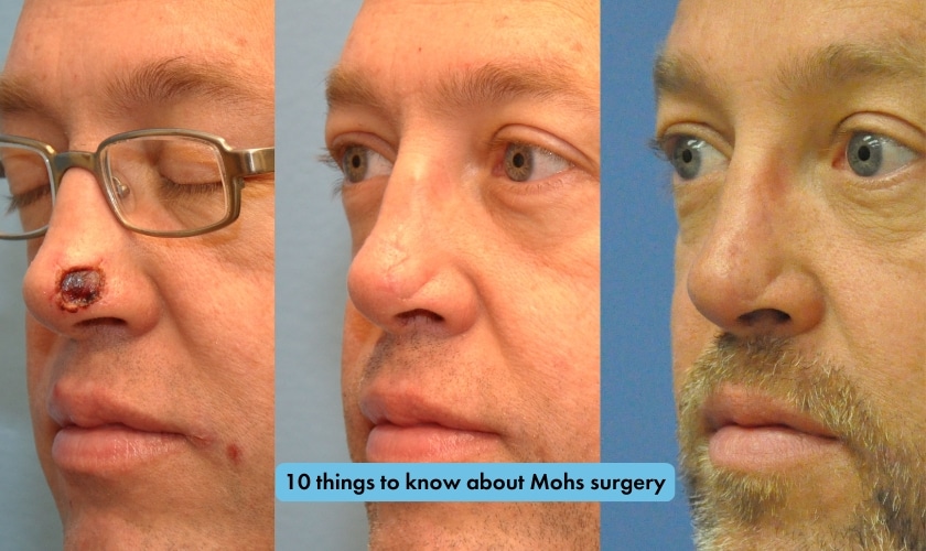 10 things to know about Mohs surgery