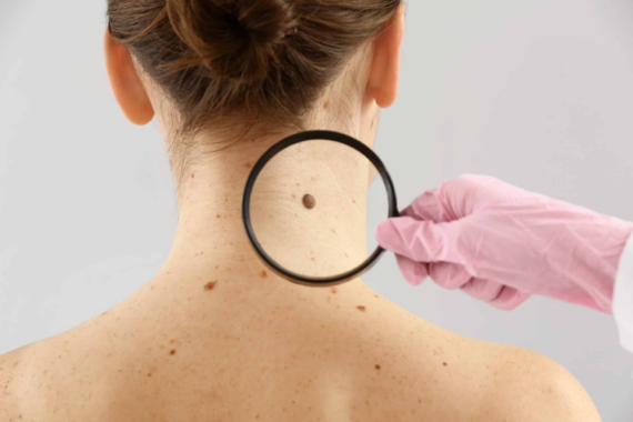 amount of skin removed in Mohs surgery