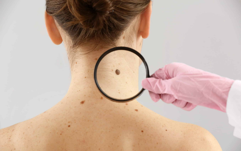 amount of skin removed in Mohs surgery