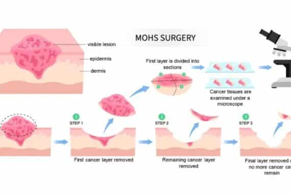 Understanding Mohs Surgery