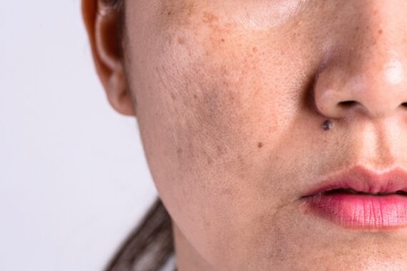 How to Protect Your Skin from Winter Dryness