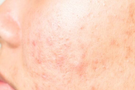 Acne Scar Revision: Effective Treatments and Real Results
