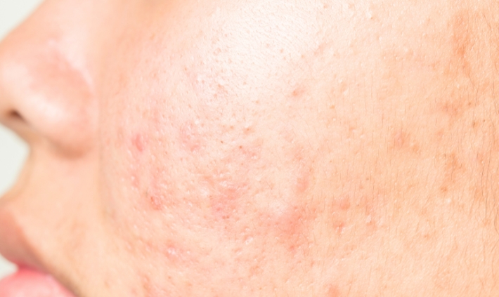 Acne Scar Revision: Effective Treatments and Real Results