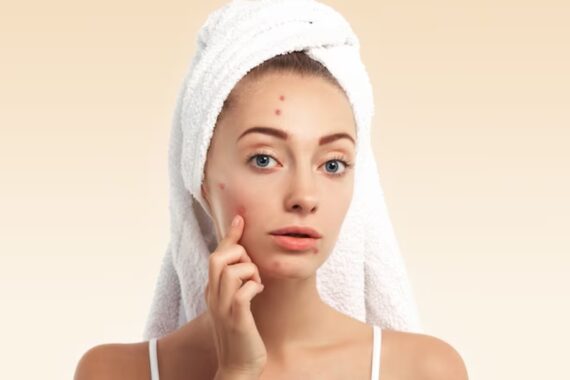 What Causes Acne and How to Treat It Effectively