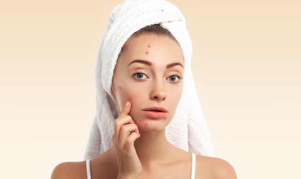 What Causes Acne and How to Treat It Effectively