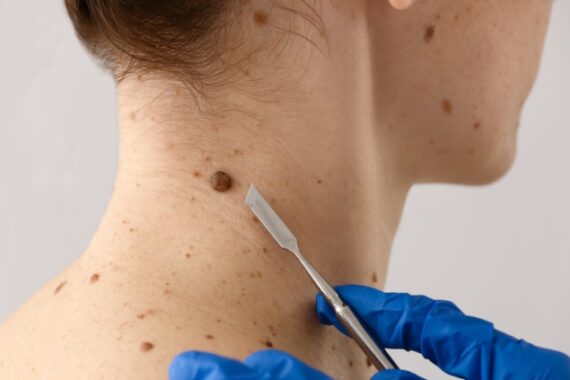 Can Surgical Dermatology Remove Moles