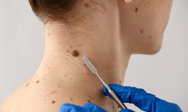 Can Surgical Dermatology Remove Moles